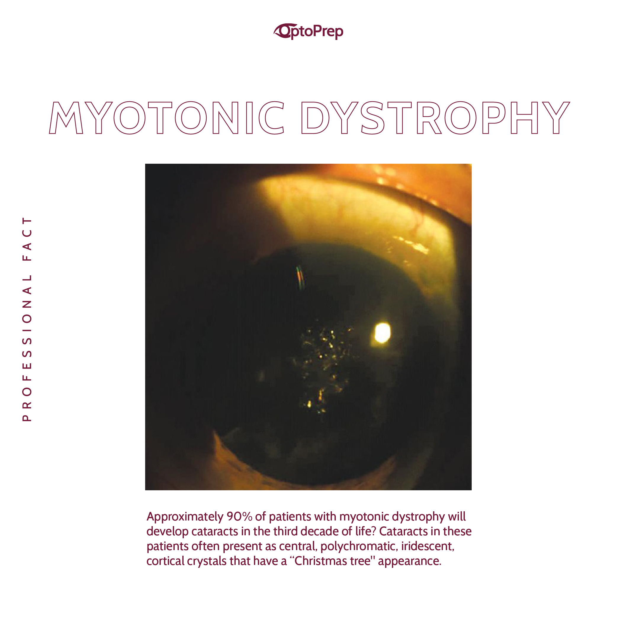 Christmas Tree Cataract Myotonic Dystrophy